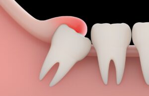 Особенности решение проблемы перикоронита в стоматологической клинике