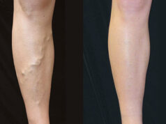 Микрофлебэктомия варикозных притоков