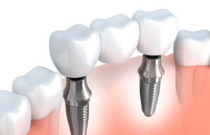 Особенности и преимущества имплантов Medent