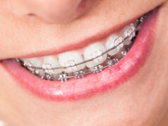 Брекеты Damon: особенности, преимущества