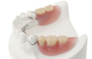 Особенности и преимущества бюгельных зубных протезов