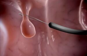 Полипы в матке