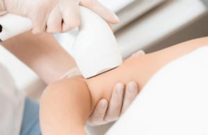 Лазерная эпиляция рук: что стоит знать о процедуре