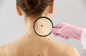 Эффективное удаление папиллом: лазерный метод