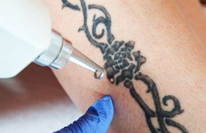 Сведение татуировки с лица