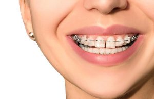 Когда назначается установка брекетов