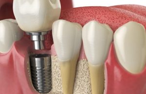 Имплантация зубов к клинике Адмирал