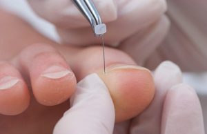 Лечение вросшего ногтя: причины вростания, как проводится лечение