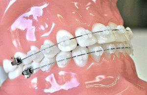 Что из себя представляют современные брекет-системы?