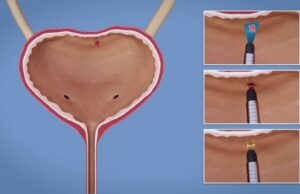 Показания и особенности ТУР мочевого пузыря