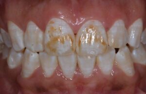 Флюороз зубов: что это такое и как лечить