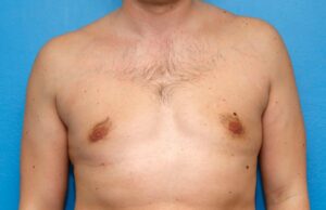 Гинекомастия: как подготовиться к операции