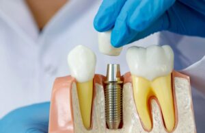 Внутрикостная дентальная имплантация: современный подход к восстановлению зубов