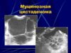Всё о муцинозной цистаденоме: симптомы, диагностика, лечение